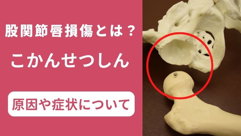 股関節唇損傷とは?原因・症状・治るまでの期間と運動療法を徹底解説