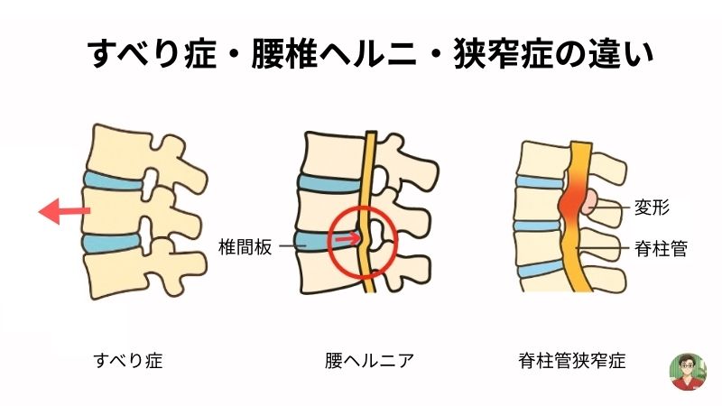 すべり症　腰椎ヘルニア　違い