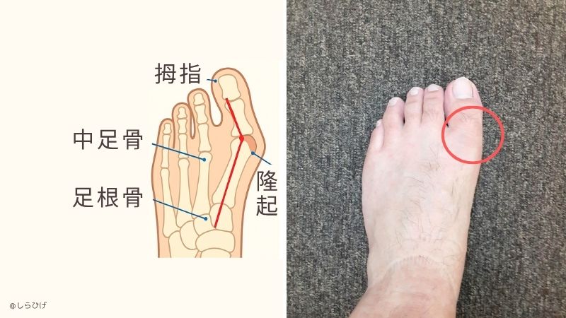 外反母趾　症状