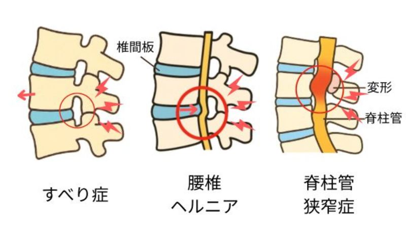 すべり症　ヘルニア　違い
